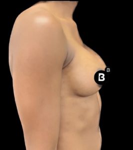 Breast Augmentation Before and After Pictures in Buffalo, NY