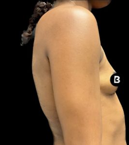 Breast Augmentation Before and After Pictures in Buffalo, NY