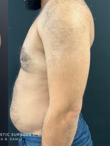 Female to Male Top Surgery Before and After Pictures in Buffalo, NY