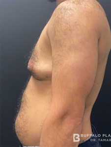 Female to Male Top Surgery Before and After Pictures in Buffalo, NY