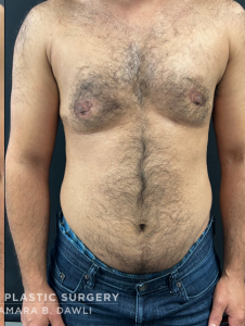 Female to Male Top Surgery Before and After Pictures in Buffalo, NY