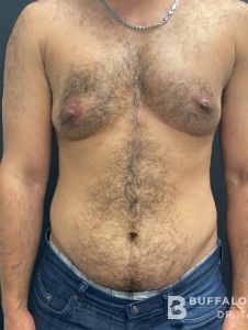 Female to Male Top Surgery Before and After Pictures in Buffalo, NY