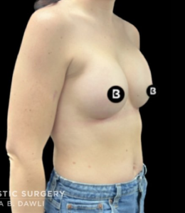 Breast Augmentation Before and After Pictures in Buffalo, NY