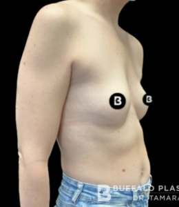 Breast Augmentation Before and After Pictures in Buffalo, NY