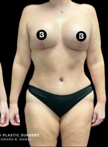 Mommy Makeover Before and After Pictures in Buffalo, NY