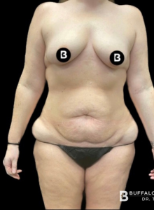 Mommy Makeover Before and After Pictures in Buffalo, NY