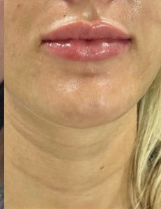 Lip Fillers Before and After Pictures in Buffalo, NY