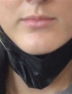Lip Fillers Before and After Pictures in Buffalo, NY