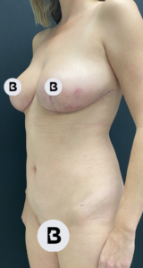 Breast Reduction Before and After Pictures in Buffalo, NY