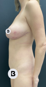 Liposuction Before and After Pictures in Buffalo, NY