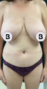 Breast Reduction Before and After Pictures in Buffalo, NY