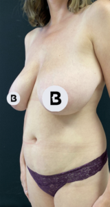 Liposuction Before and After Pictures in Buffalo, NY