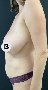 Breast Reduction Before and After Pictures in Buffalo, NY