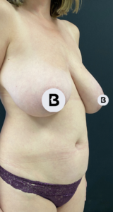 Liposuction Before and After Pictures in Buffalo, NY