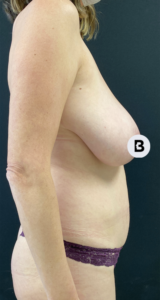Breast Reduction Before and After Pictures in Buffalo, NY