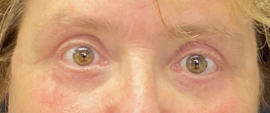 Blepharoplasty (Eyelid Surgery) Before and After Pictures in Buffalo, NY