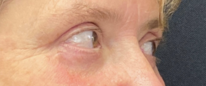 Blepharoplasty (Eyelid Surgery) Before and After Pictures in Buffalo, NY