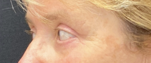 Blepharoplasty (Eyelid Surgery) Before and After Pictures in Buffalo, NY