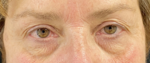 Blepharoplasty (Eyelid Surgery) Before and After Pictures in Buffalo, NY