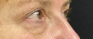 Blepharoplasty (Eyelid Surgery) Before and After Pictures in Buffalo, NY