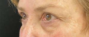 Blepharoplasty (Eyelid Surgery) Before and After Pictures in Buffalo, NY