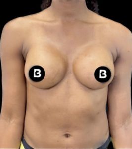 Breast Augmentation Before and After Pictures in Buffalo, NY