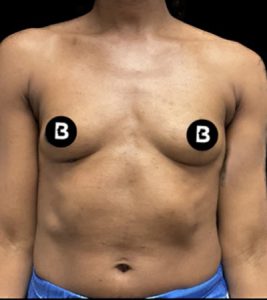 Breast Augmentation Before and After Pictures in Buffalo, NY