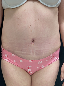 Abdominoplasty (Tummy Tuck) Before and After Pictures Buffalo, NY