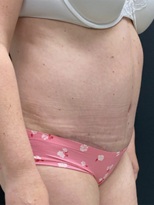 Abdominoplasty (Tummy Tuck) Before and After Pictures Buffalo, NY