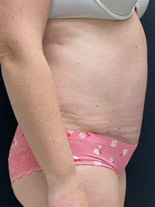 Abdominoplasty (Tummy Tuck) Before and After Pictures Buffalo, NY