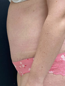 Abdominoplasty (Tummy Tuck) Before and After Pictures Buffalo, NY