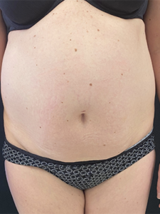 Abdominoplasty (Tummy Tuck) Before and After Pictures Buffalo, NY