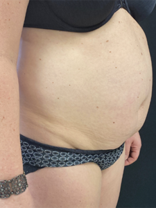 Abdominoplasty (Tummy Tuck) Before and After Pictures Buffalo, NY