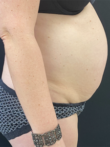 Abdominoplasty (Tummy Tuck) Before and After Pictures Buffalo, NY