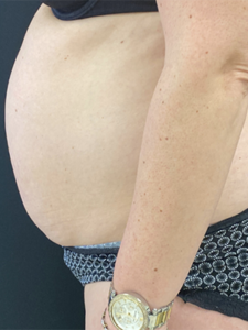 Abdominoplasty (Tummy Tuck) Before and After Pictures Buffalo, NY
