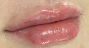 Lip Fillers Before and After Pictures Buffalo, NY