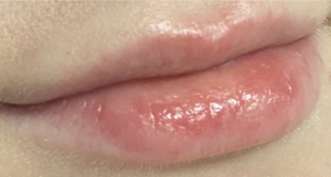 Lip Fillers Before and After Pictures Buffalo, NY