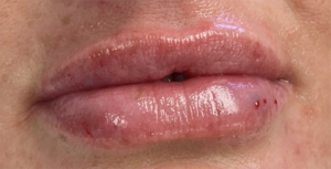 Lip Fillers Before and After Pictures Buffalo, NY