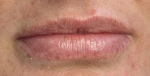 Lip Fillers Before and After Pictures Buffalo, NY