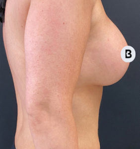 Breast Augmentation Before and After Pictures Buffalo, NY
