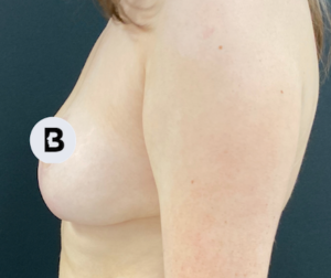 Breast Reduction Before and After Pictures in Buffalo, NY