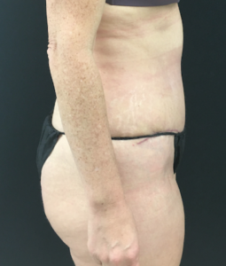 Abdominoplasty (Tummy Tuck) Before and After Pictures Buffalo, NY