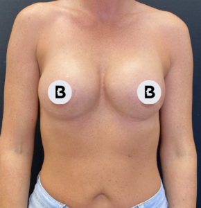 Breast Augmentation Before and After Pictures Buffalo, NY