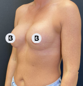 Breast Augmentation Before and After Pictures Buffalo, NY