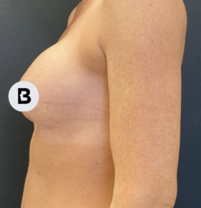 Breast Augmentation Before and After Pictures Buffalo, NY