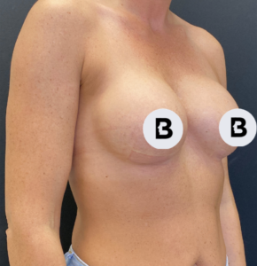 Breast Augmentation Before and After Pictures Buffalo, NY