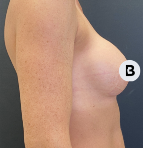 Breast Augmentation Before and After Pictures Buffalo, NY