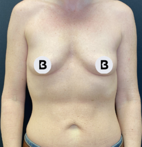 Breast Augmentation Before and After Pictures Buffalo, NY