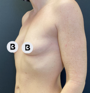 Breast Augmentation Before and After Pictures Buffalo, NY