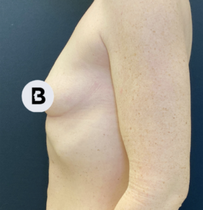Breast Augmentation Before and After Pictures Buffalo, NY